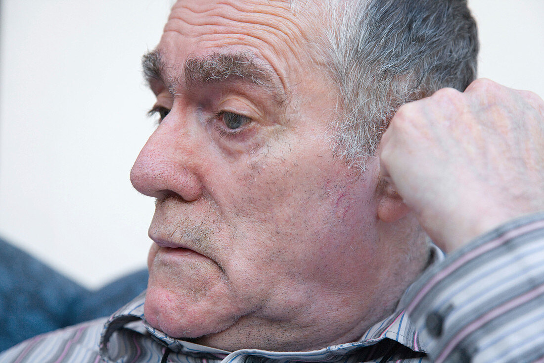 Man with Alzheimer's Disease looking thoughtful