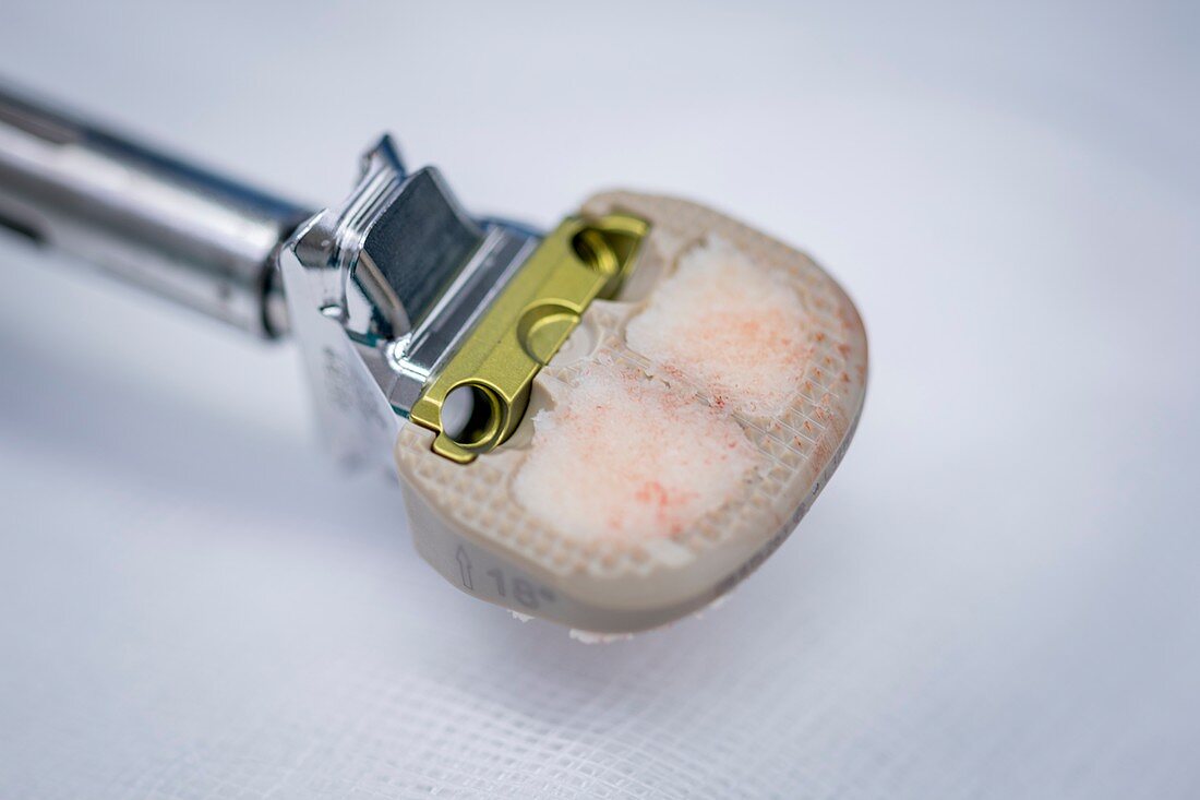 Spinal fusion implant and bone graft paste
