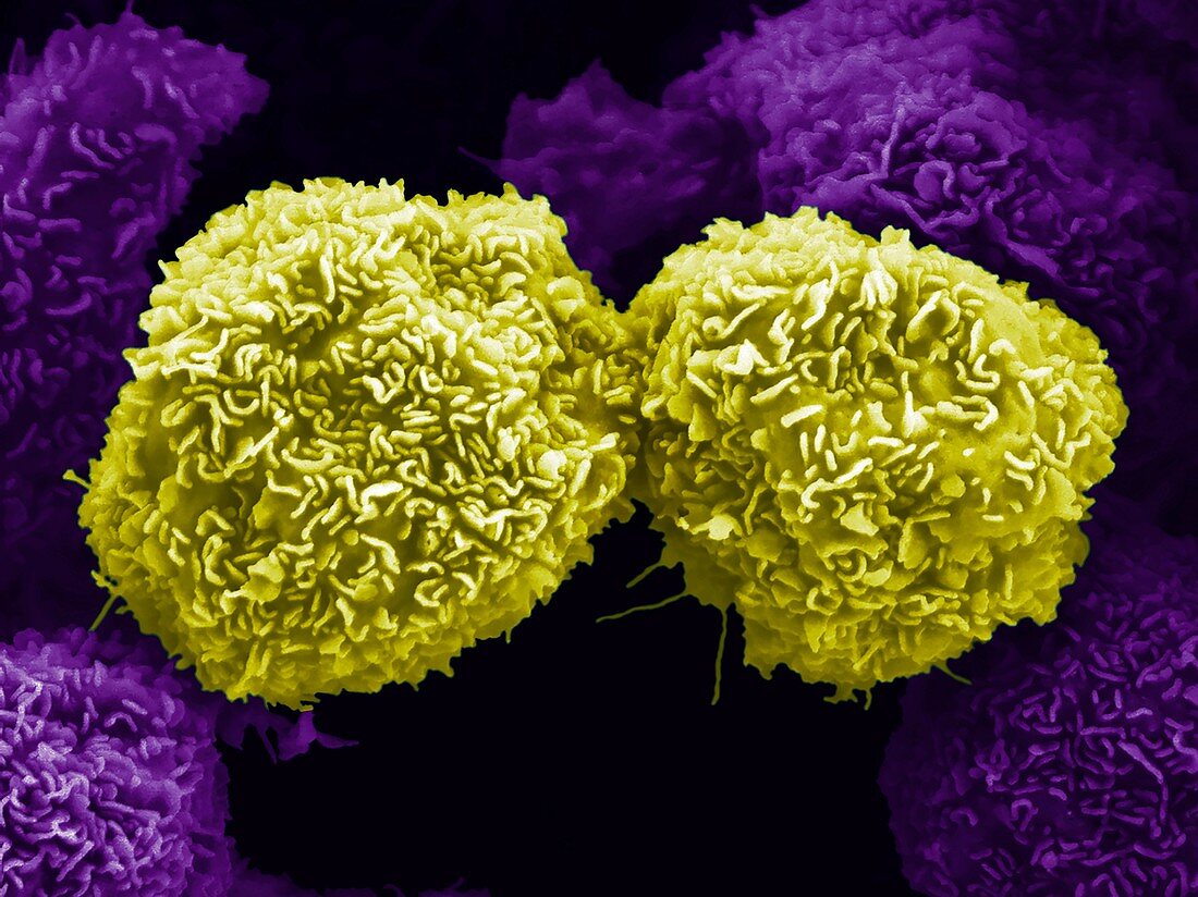 Pancreatic cancer cells,SEM