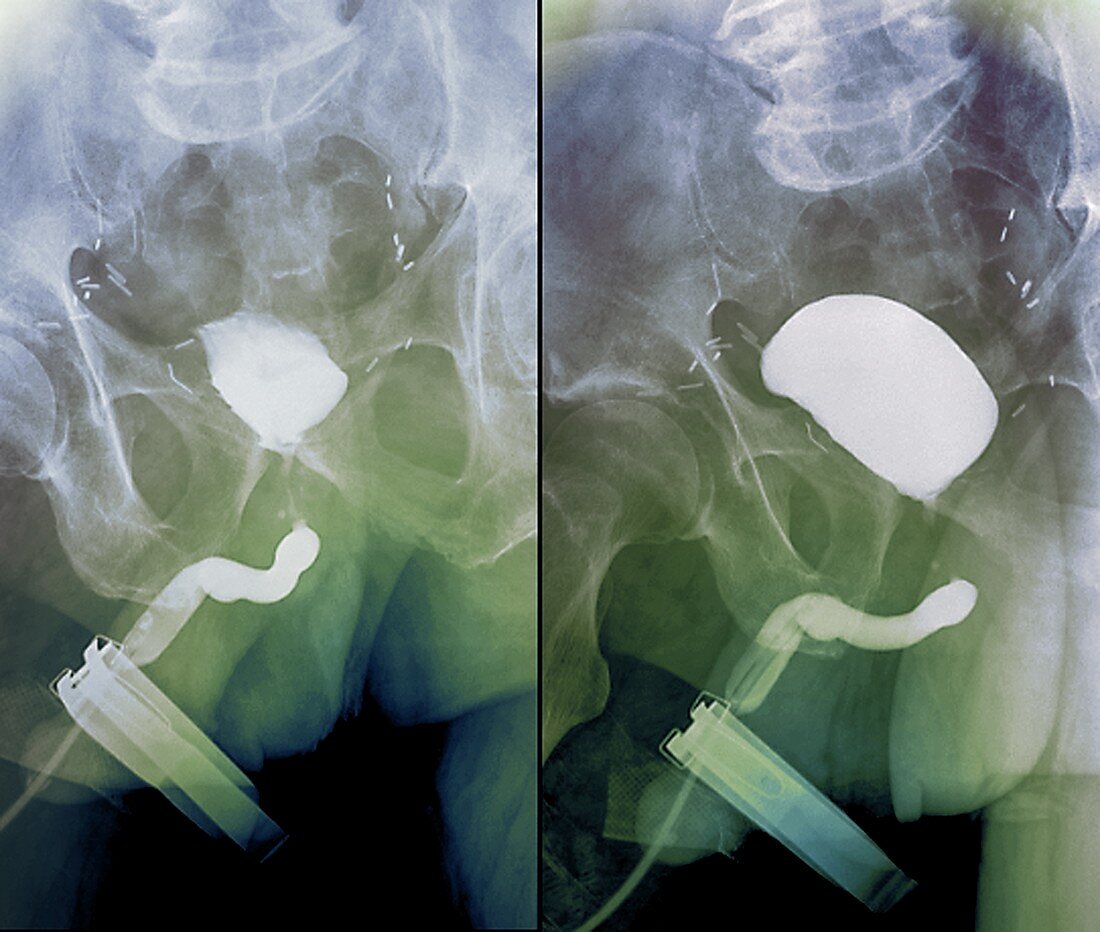 Bladder after prostate removal,X-ray
