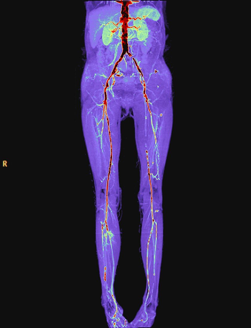 Vascular disease,CT scan
