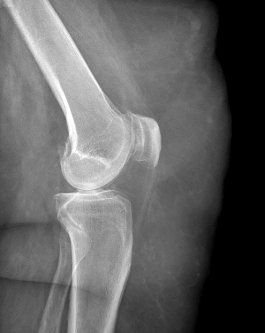 Osteoarthritis of the knee in obesity,X-ray