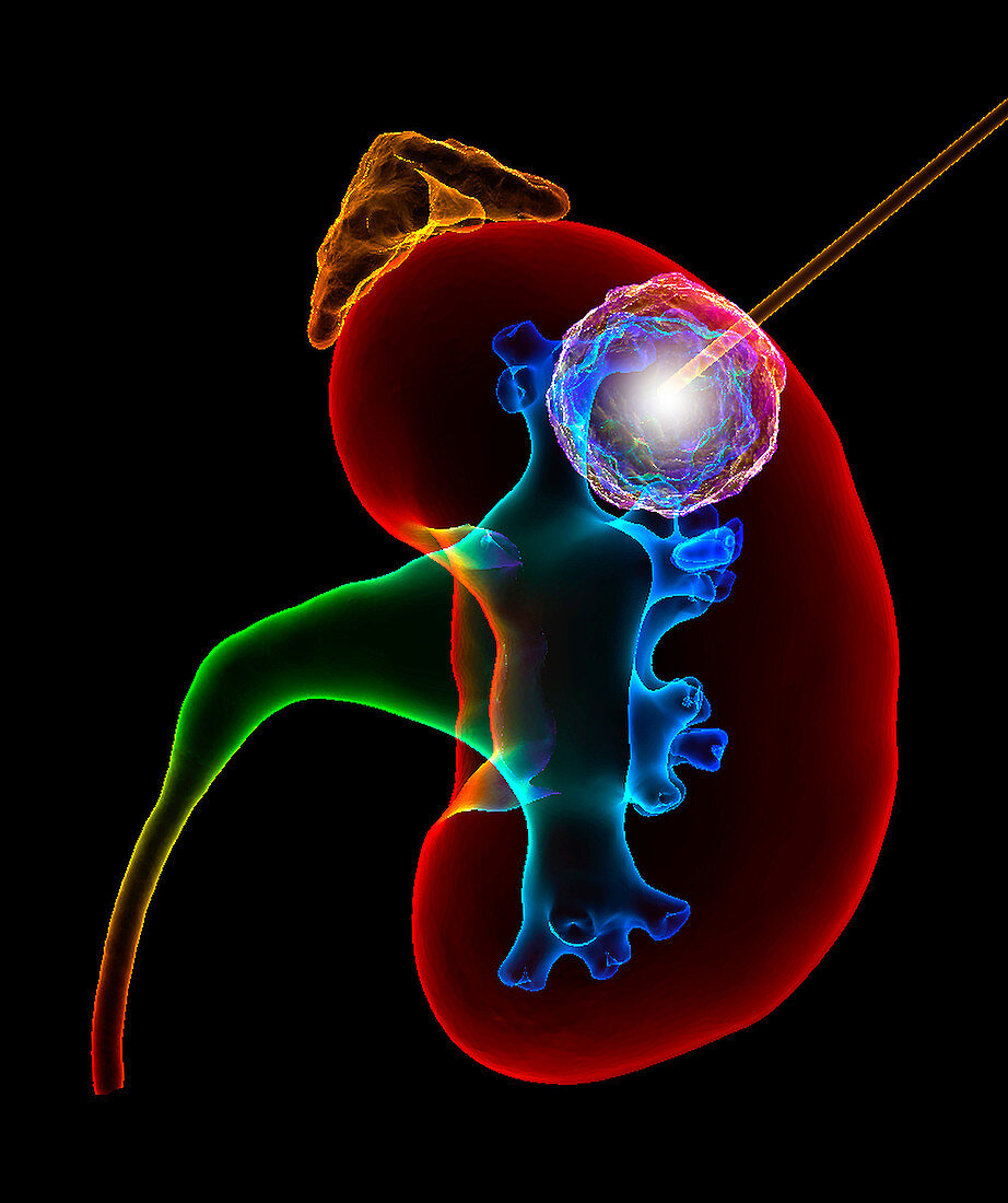 Kidney cancer thermal ablation,illustration