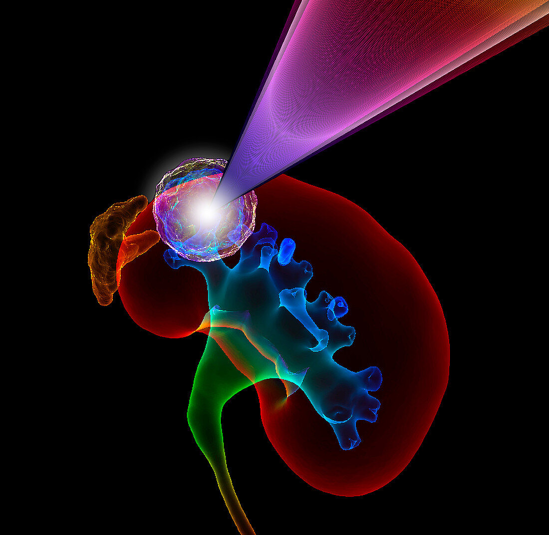 Kidney cancer radiotherapy,illustration