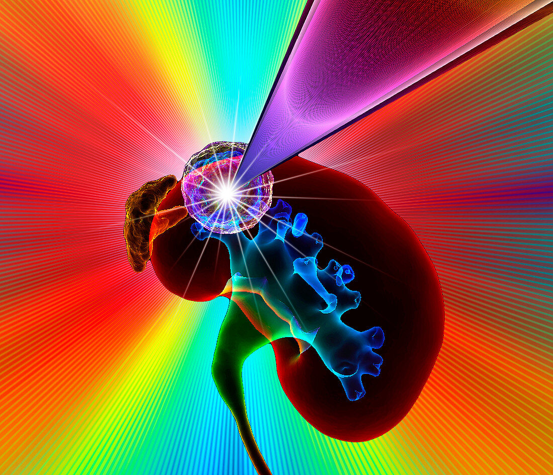 Kidney cancer radiotherapy,illustration