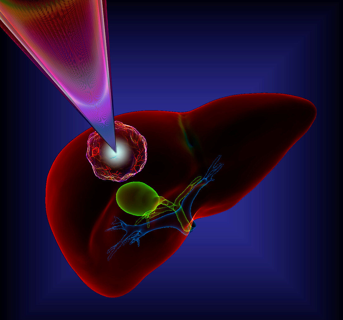 Liver cancer radiotherapy,illustration