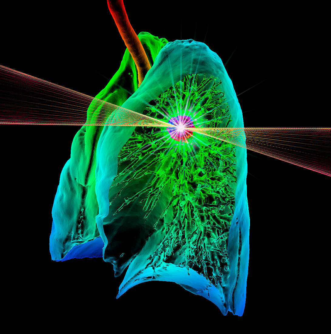 Lung cancer radiotherapy,3D CT-based illustration