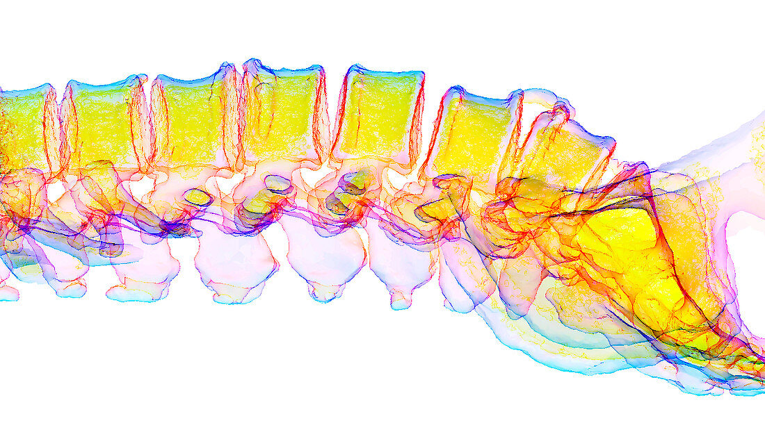 Spinal degeneration,3D CT scan