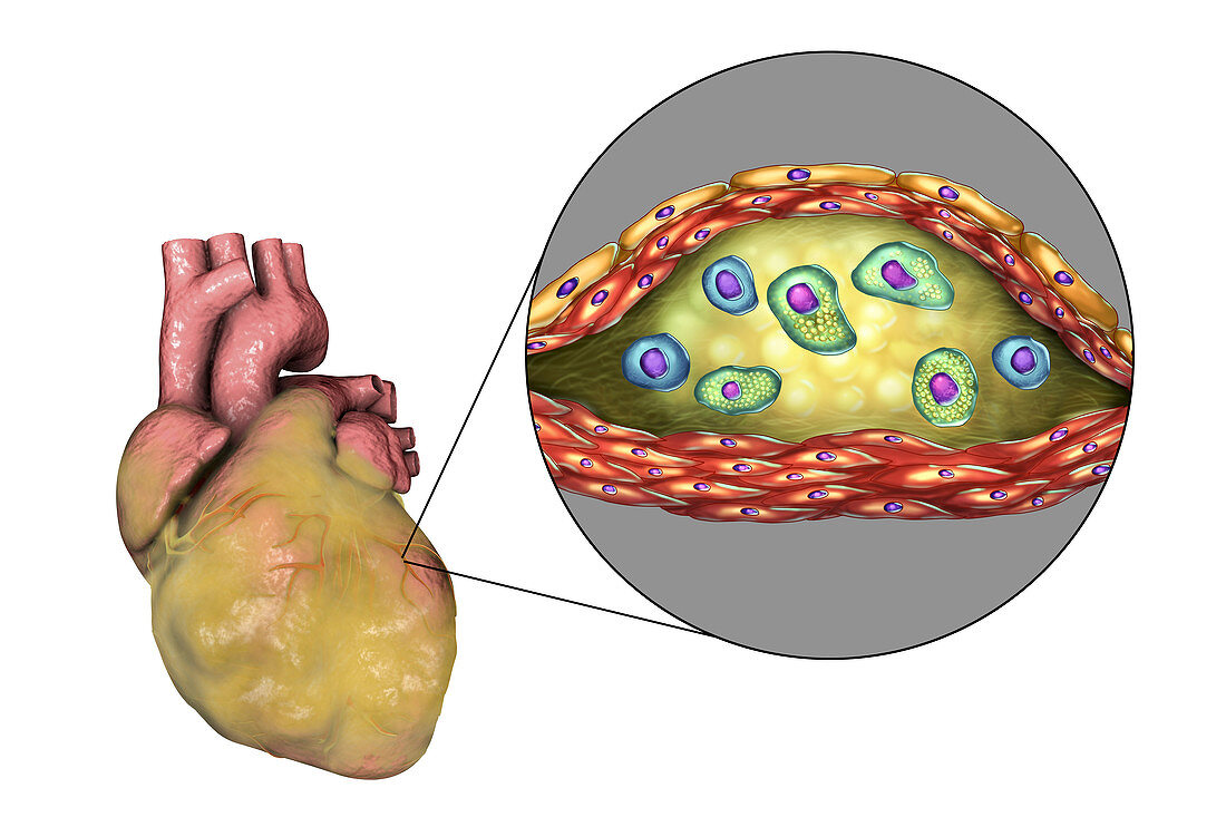Heart disease,illustration