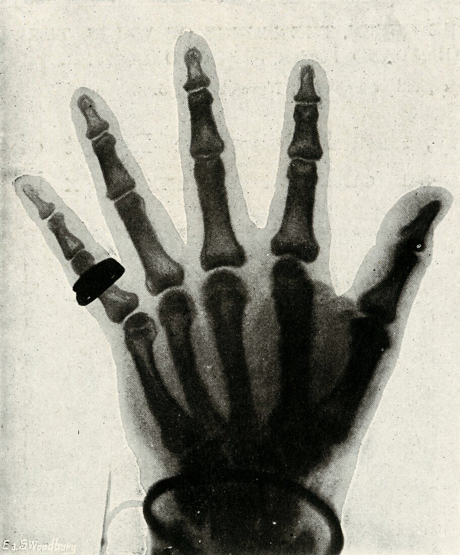 Radiograph of the Hand of HRH The Prince of Wales, (c1897)