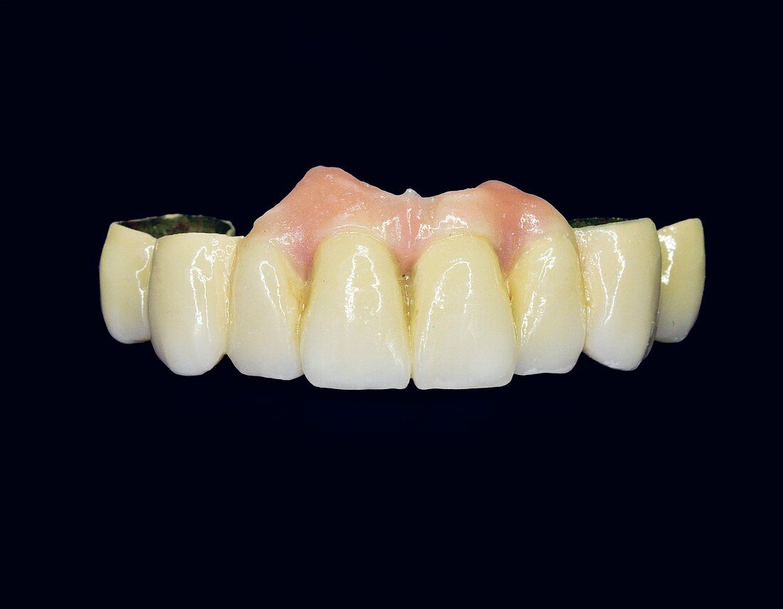 Dental ceramic bridge with artificial gums