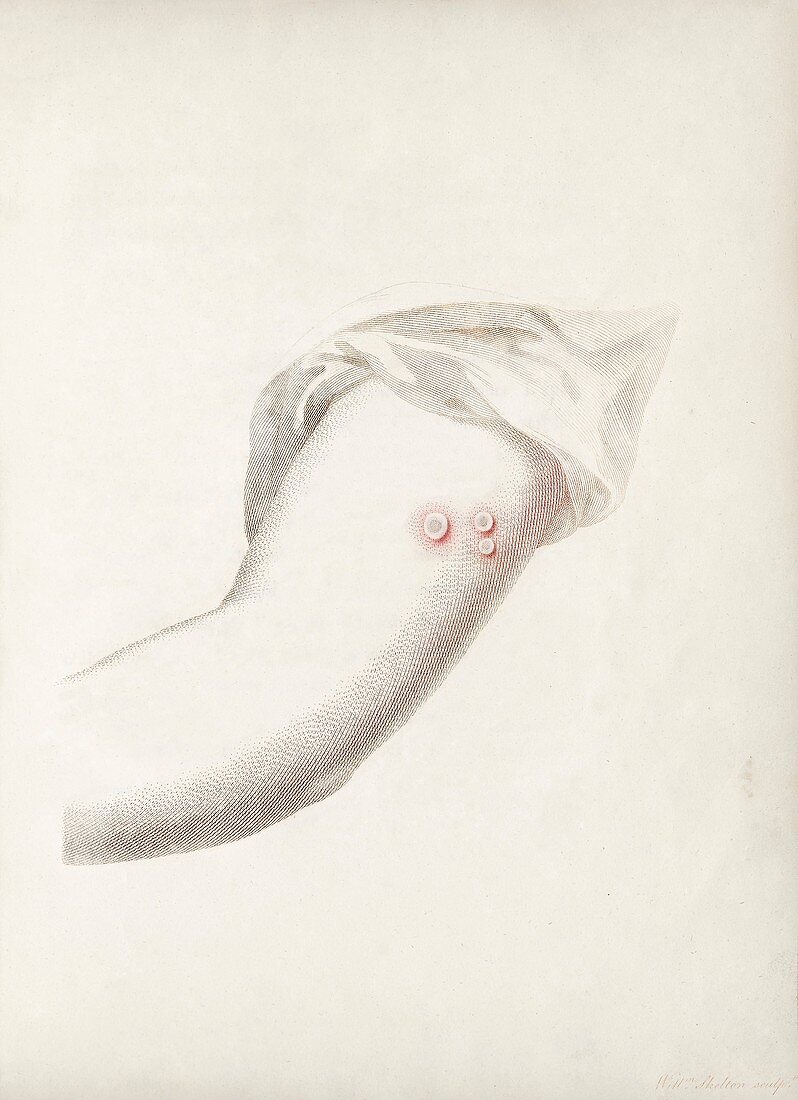 Cowpox, illustration from Edward Jenner's book