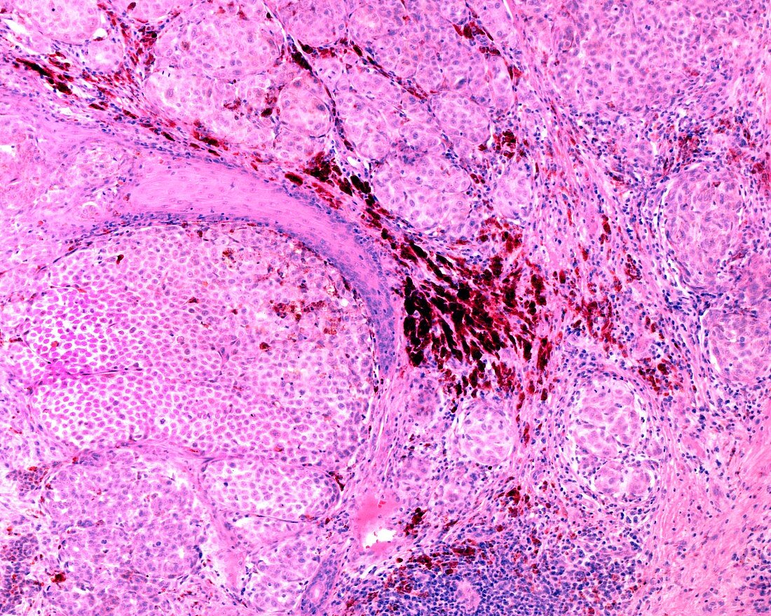 Nevoepithelioma, light micrograph