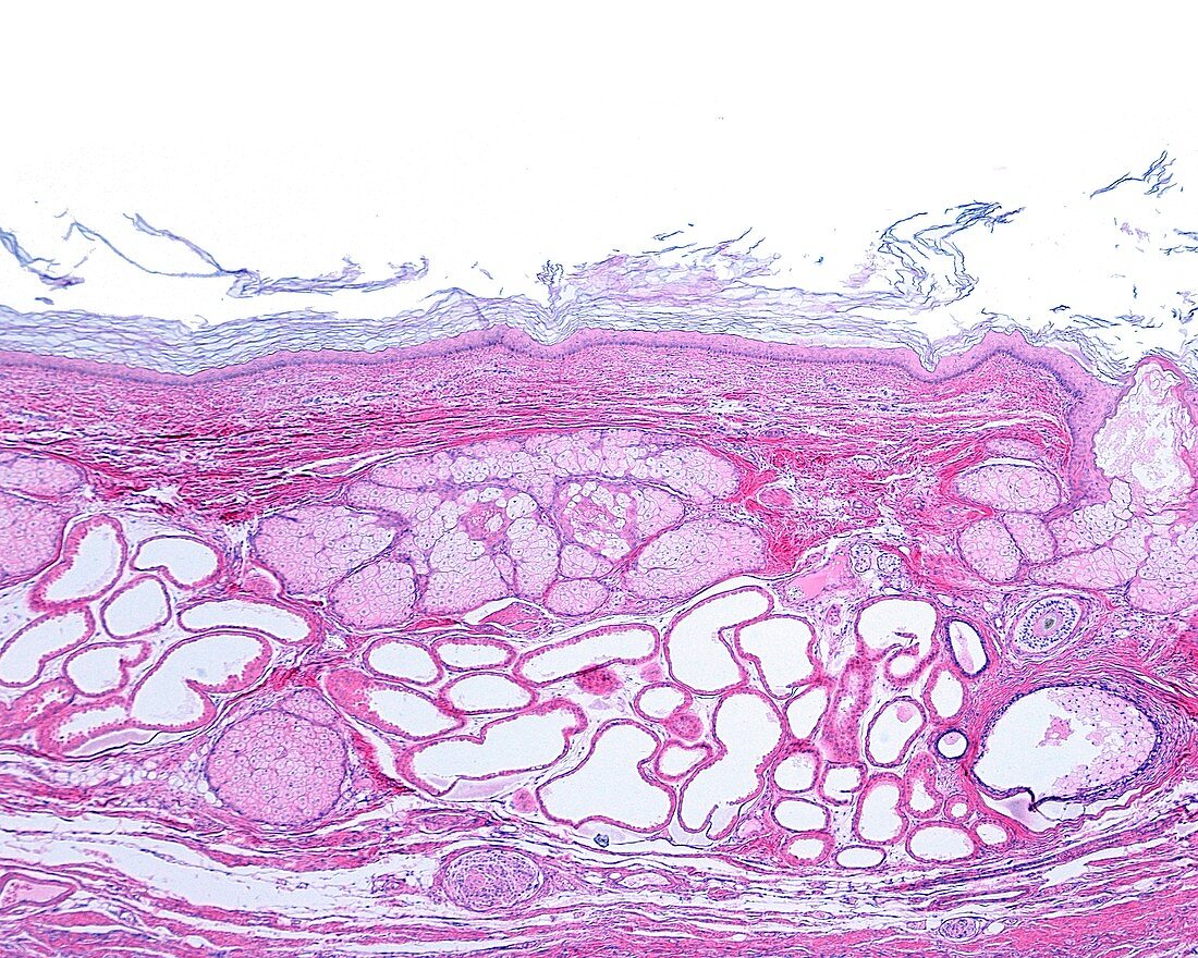 Skin dermoid cyst, light micrograph