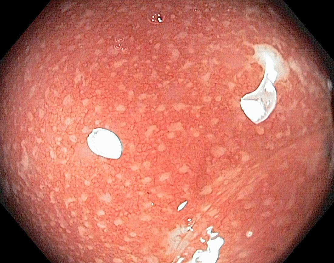 Colon in ulcerative colitis, endoscope view