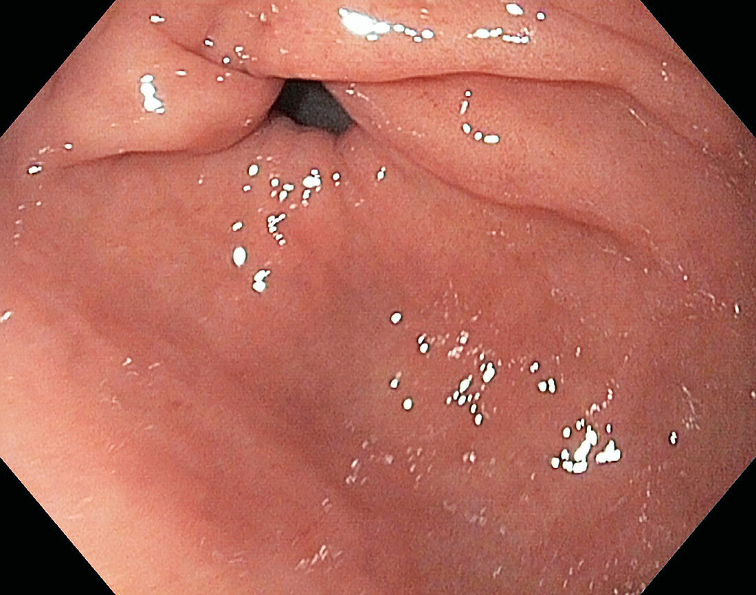 Gastric fundus, endoscope view