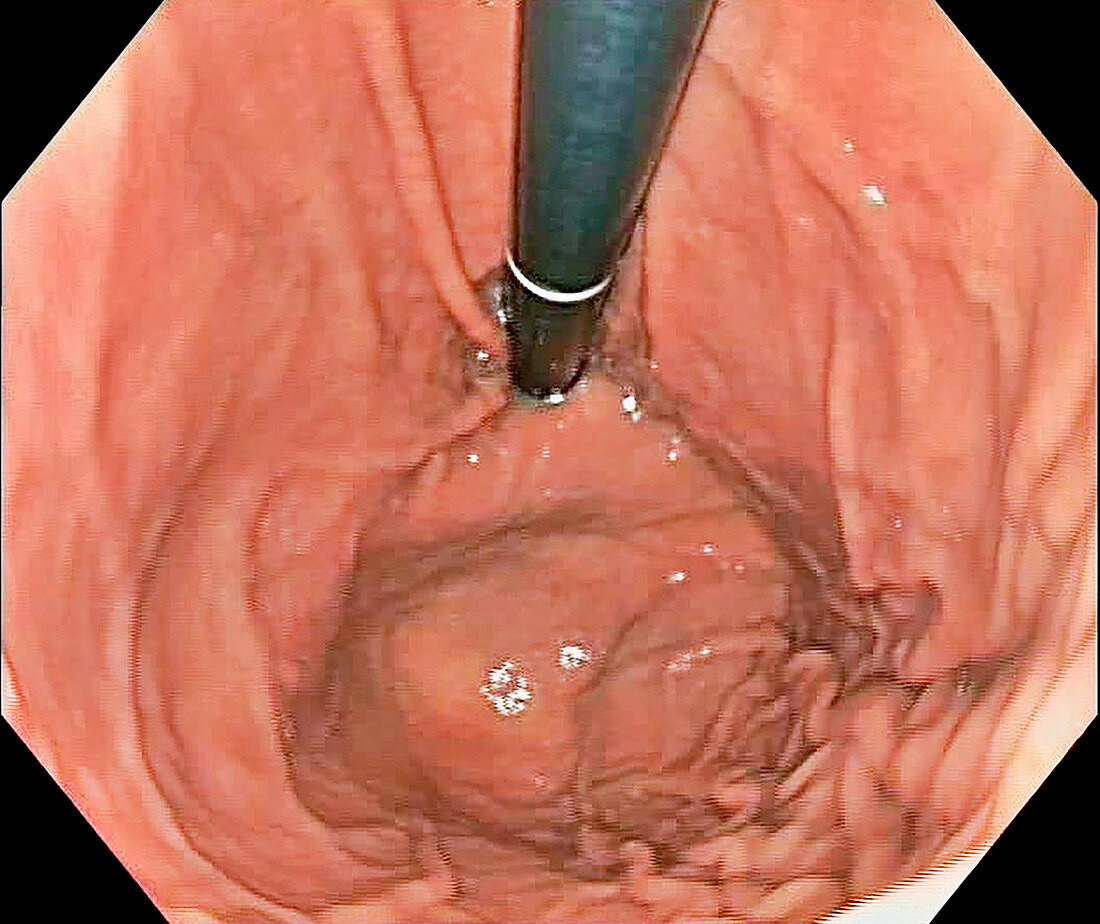 Gastric fundus, endoscope view