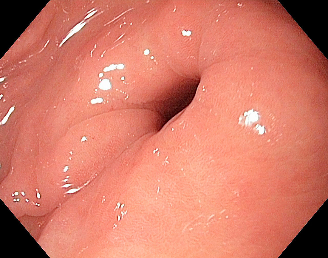 Pylorus and gastric antrum, endoscope view