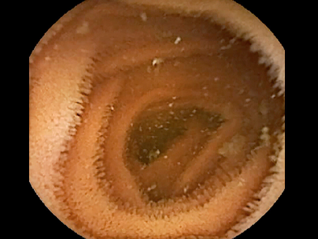 Small intestine, pill camera view