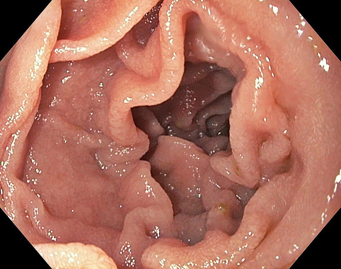 Small intestine, endoscope view