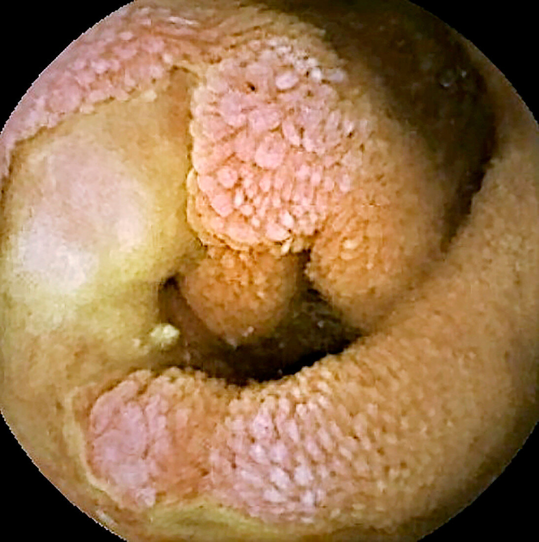 Small intestine in Crohn's disease, pill camera view