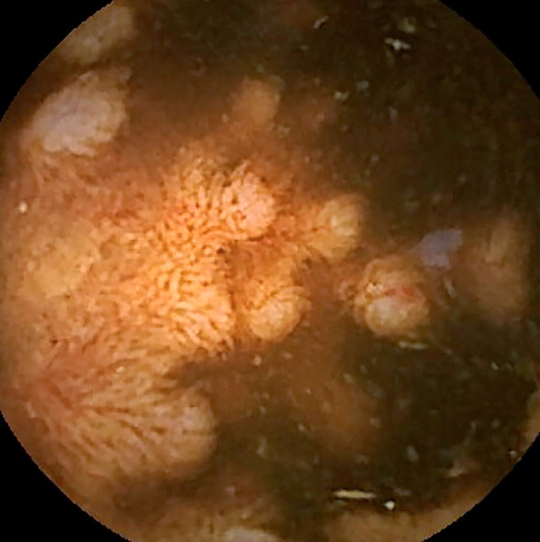 Intestinal lymphoid hyperplasia, pill camera view