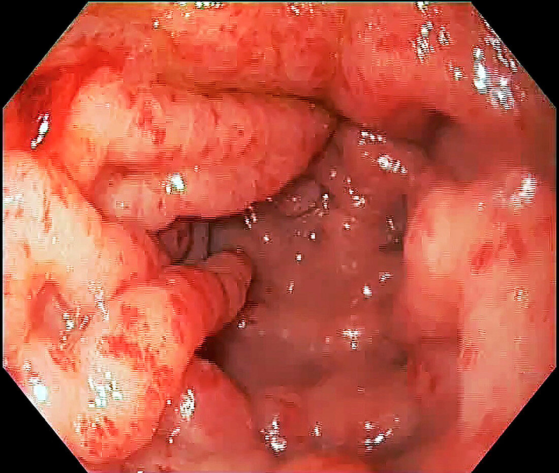 Gastric antral vascular ectasia, endoscope view