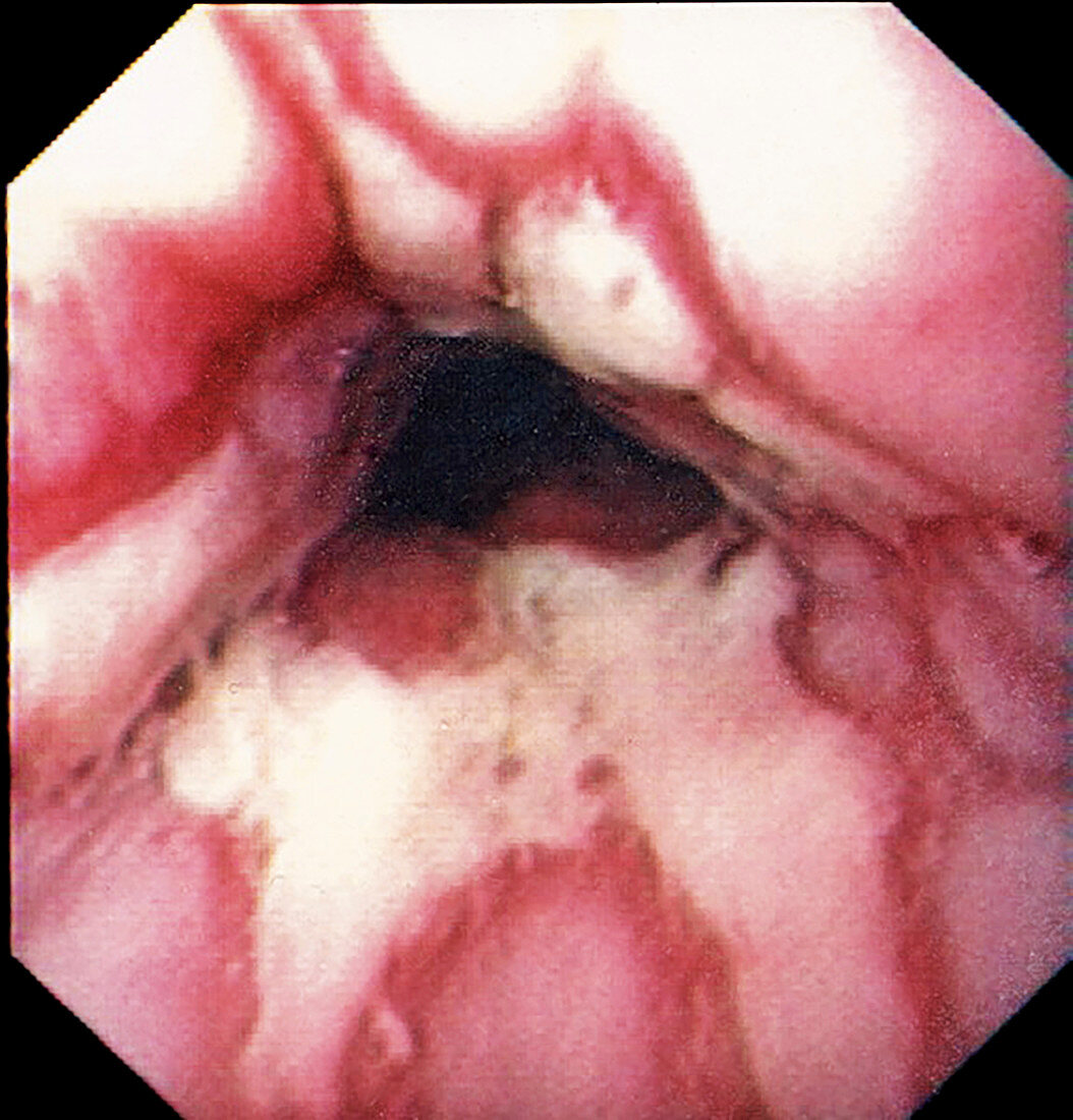 Inflamation of the oesophagus, endoscope view