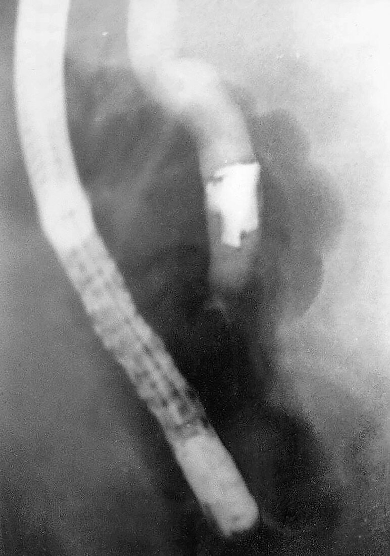 Grenade splinter causing biliary obstruction, X-ray