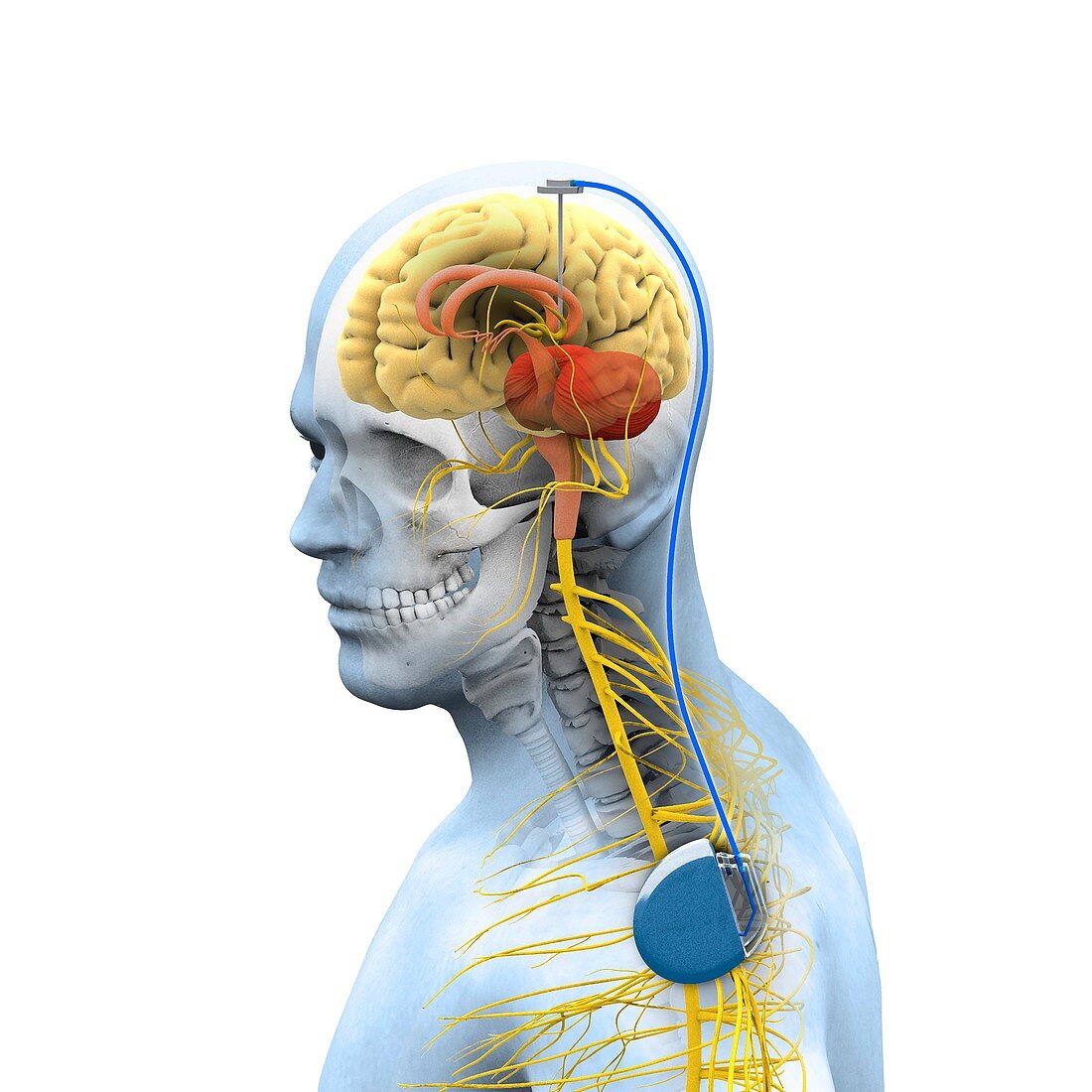Deep brain stimulation, illustration