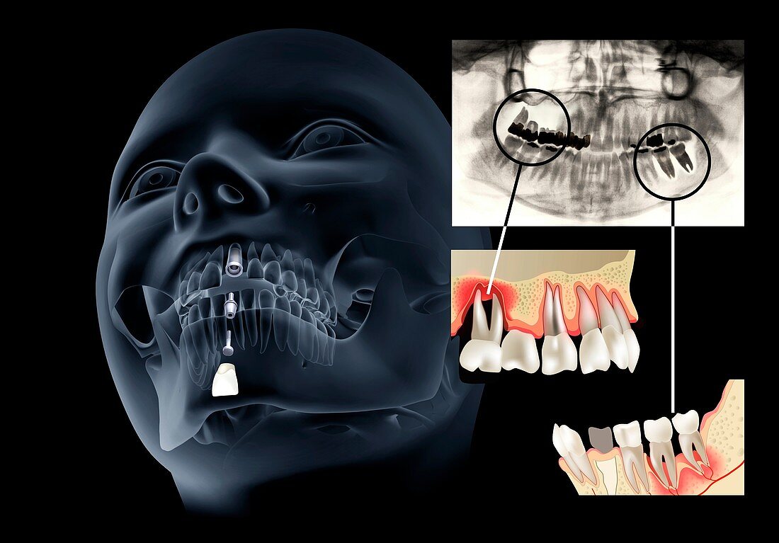 Periodontitis and dental implants, illustration