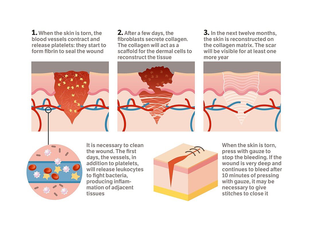 Wound healing, illustration