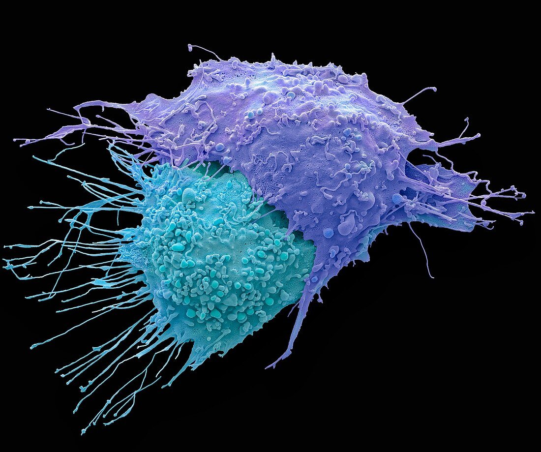 Ovarian cancer cells, sem