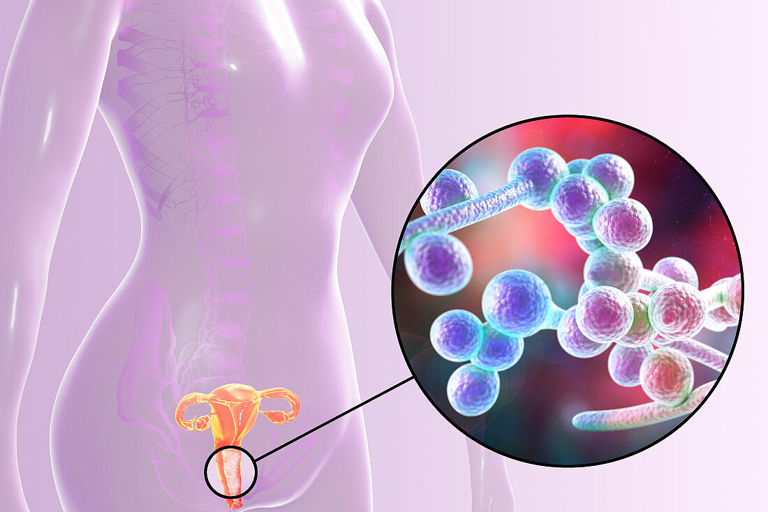 Candida albicans infection in female, illustration