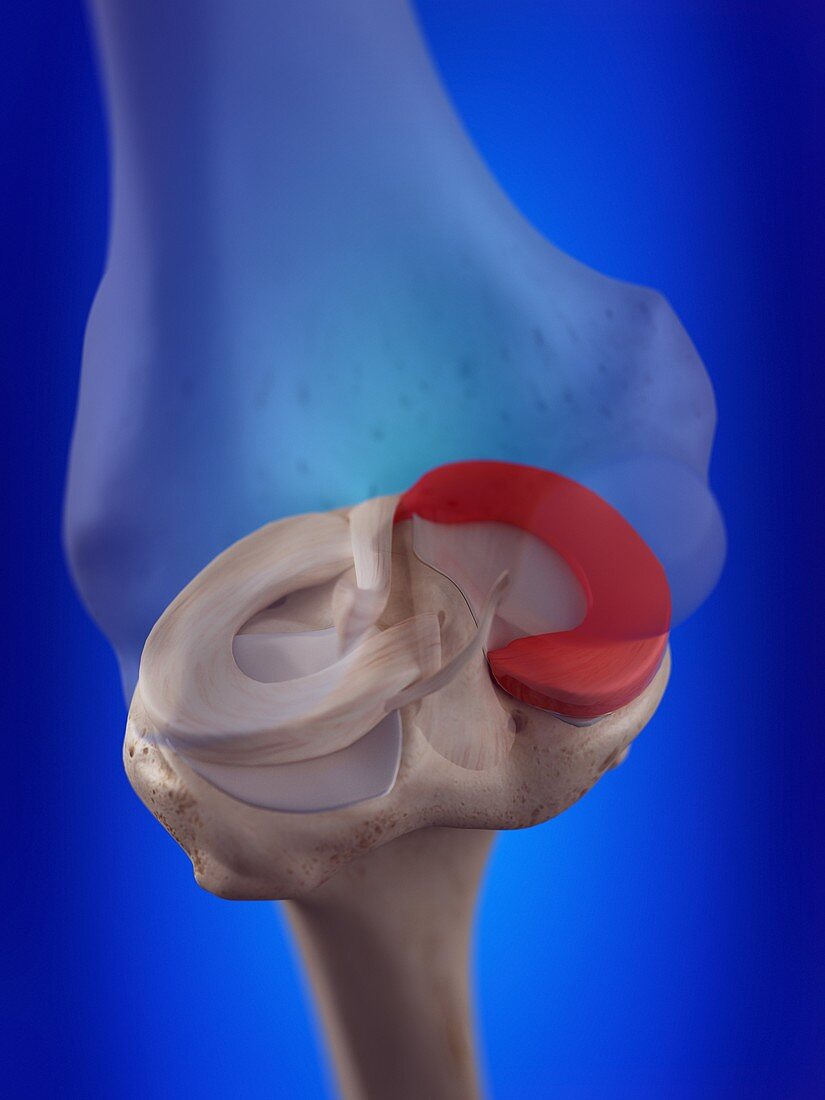 Illustration of the medial meniscus