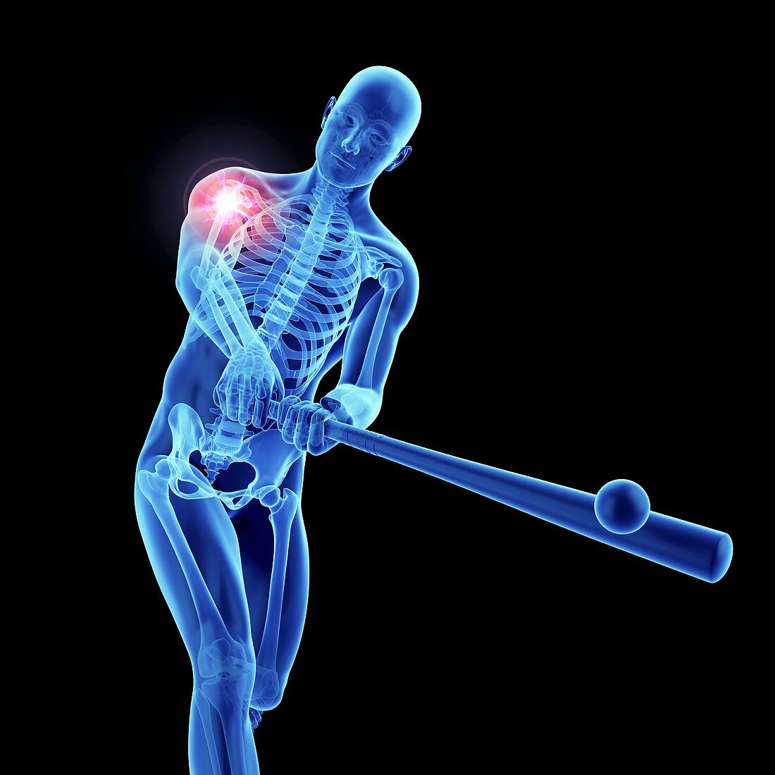 Illustration of an athlete's painful shoulder