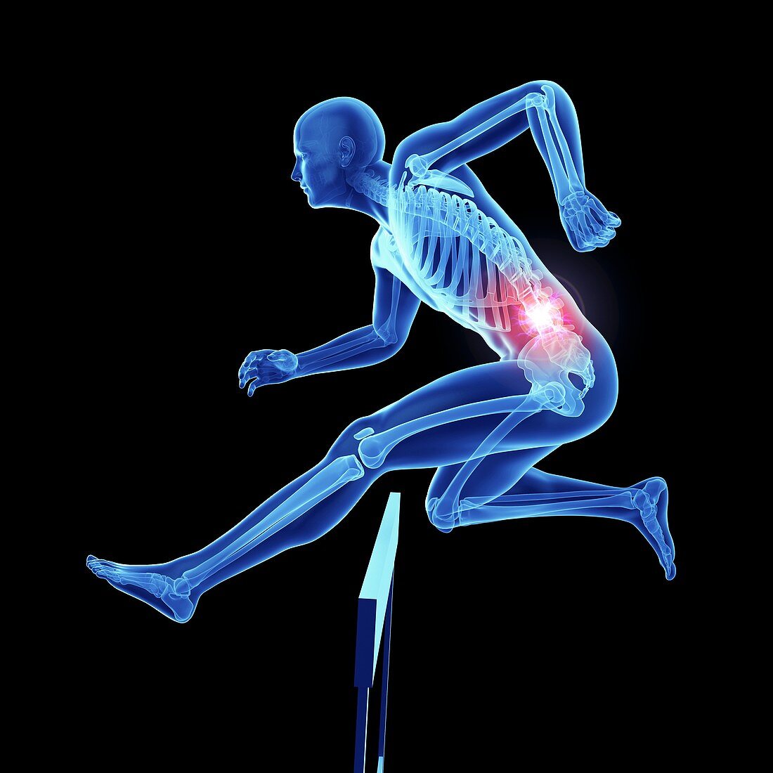 Illustration of an athlete's painful back