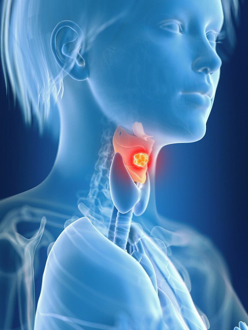 Illustration of female larynx cancer