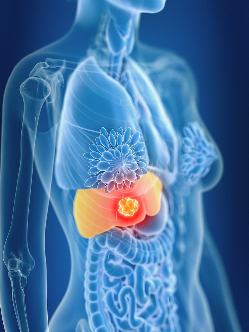 Illustration of female liver cancer