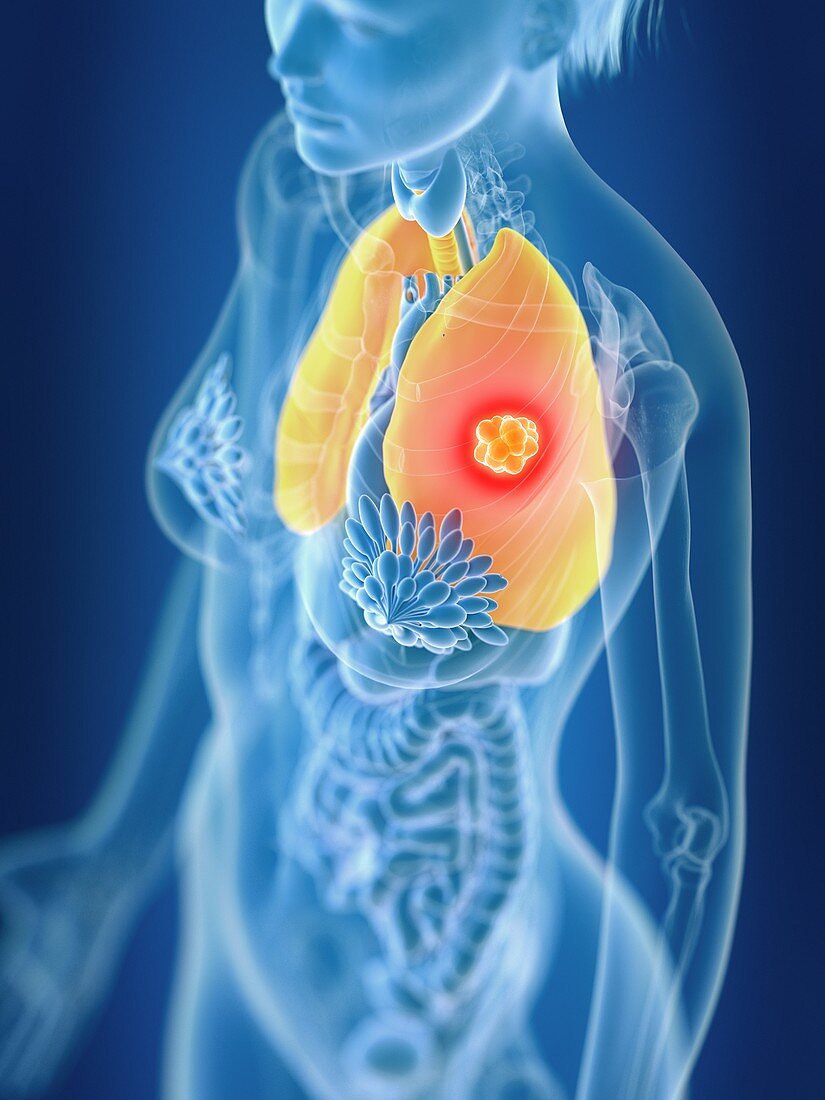 Illustration of female lung cancer