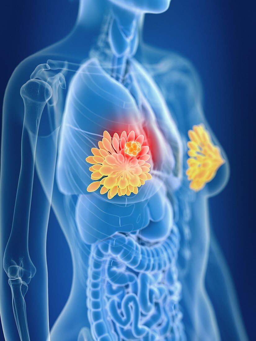 Illustration of female mammary glands cancer