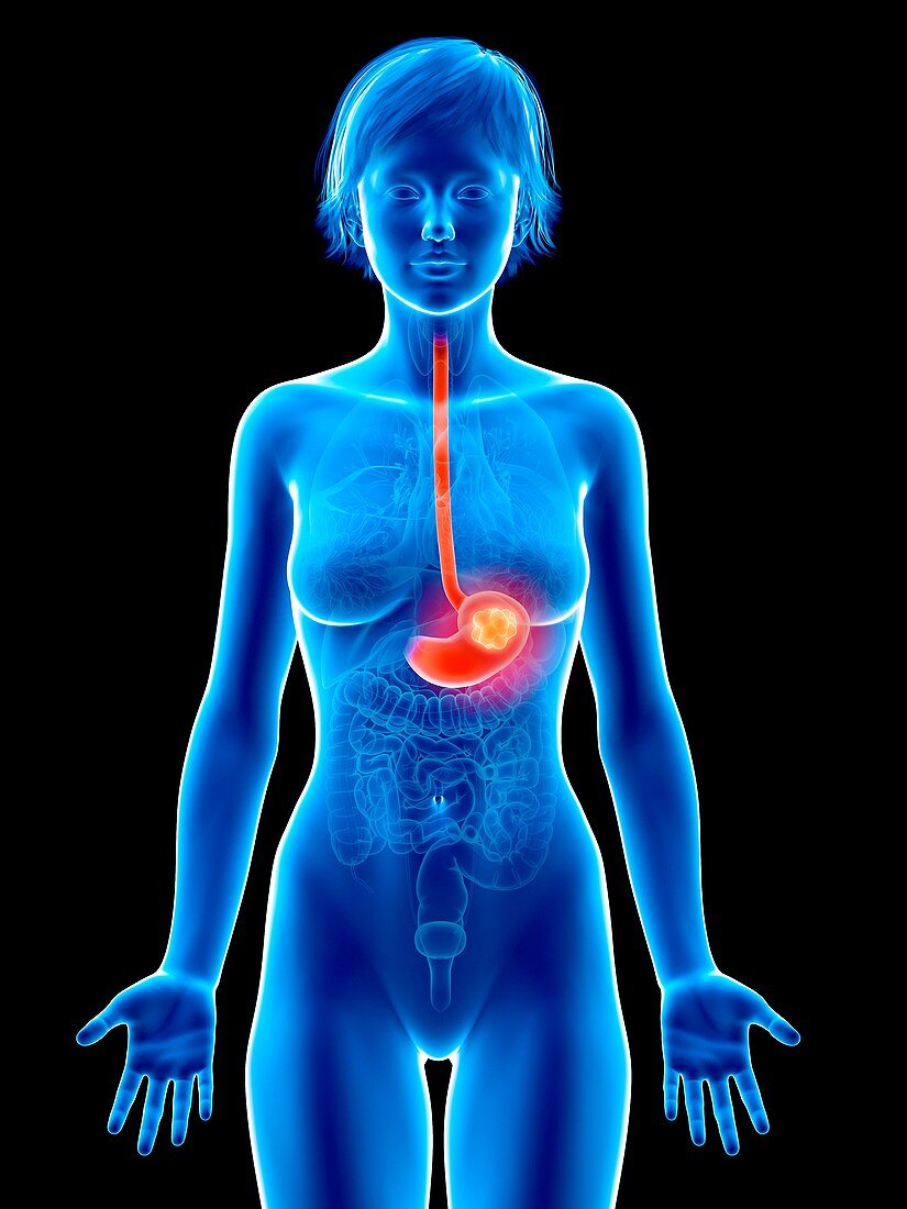 Illustration of stomach cancer