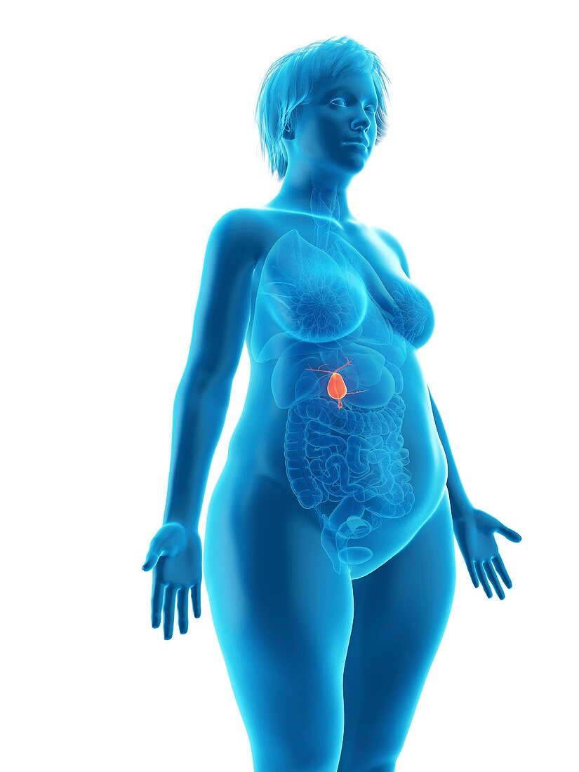 Illustration of an obese woman's gallbladder