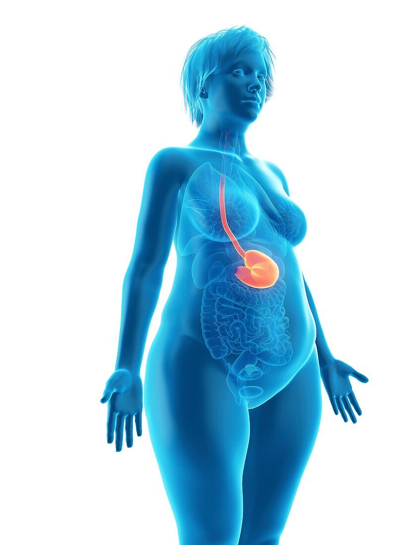 Illustration of an obese woman's stomach