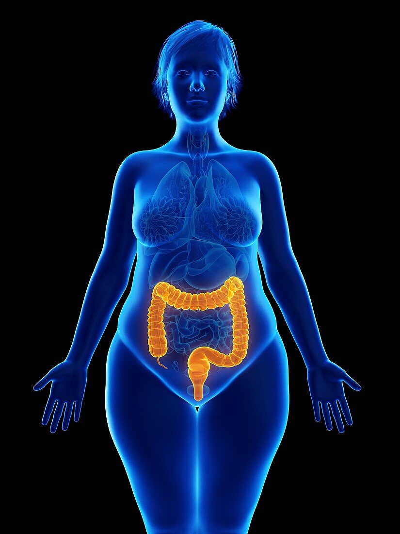 Illustration of an obese woman's colon