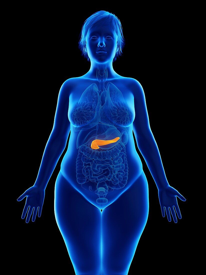 Illustration of an obese woman's pancreas