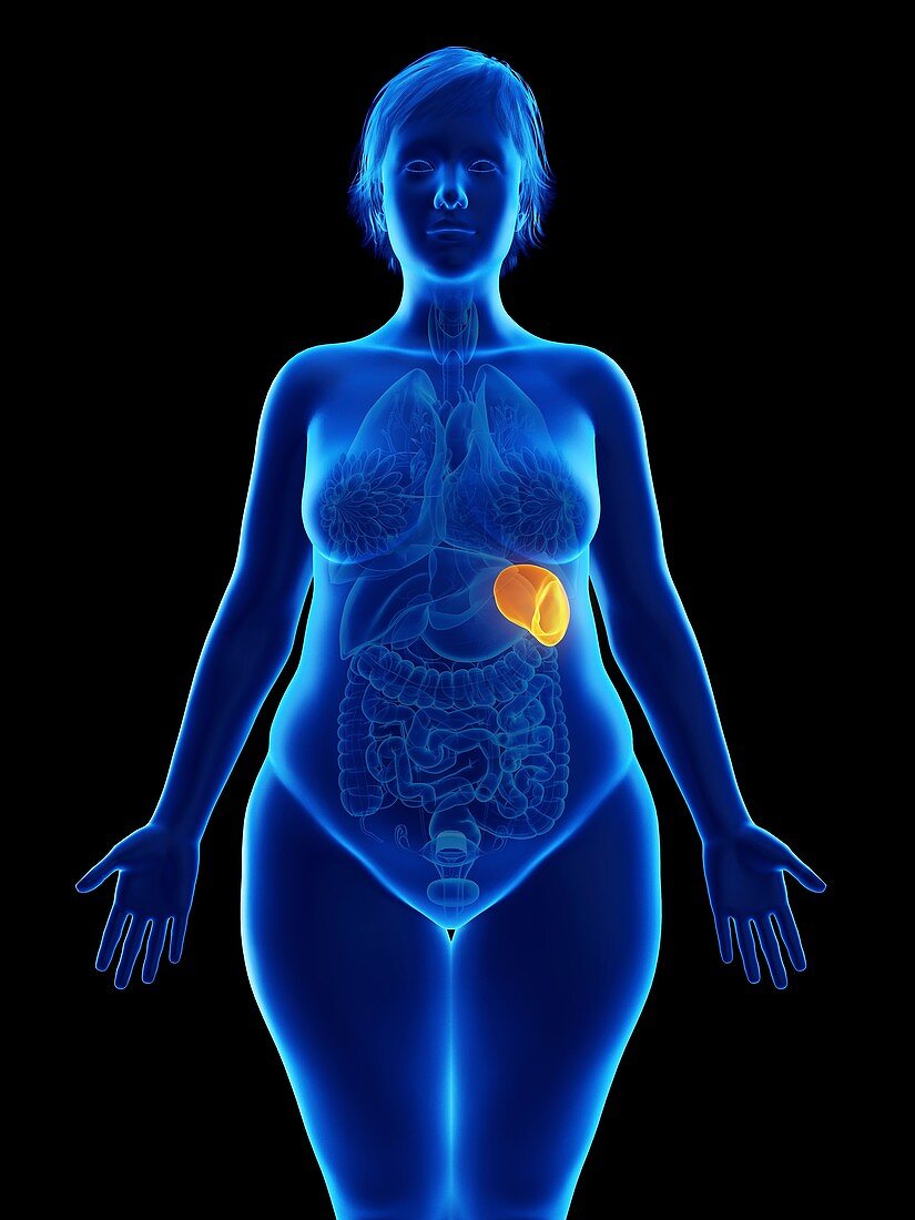 Illustration of an obese woman's spleen