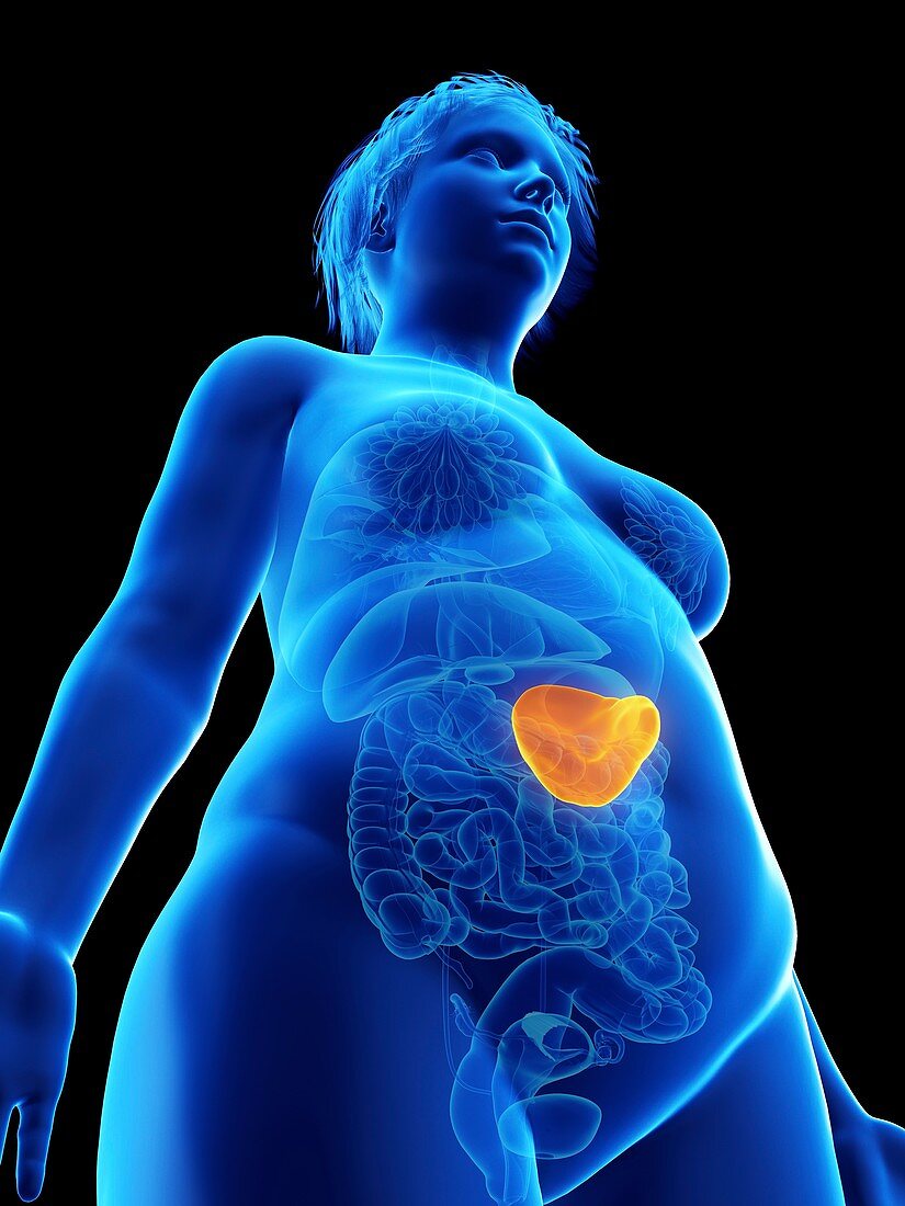 Illustration of an obese woman's spleen