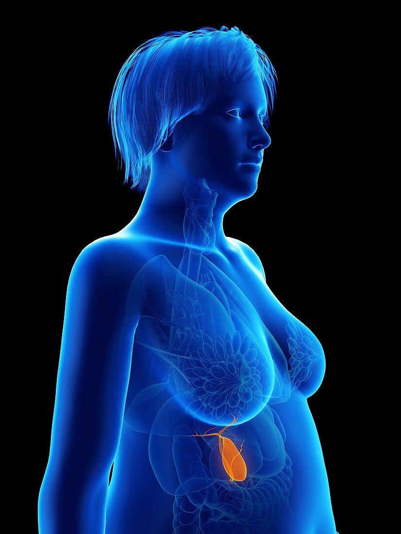 Illustration of an obese woman's gallbladder