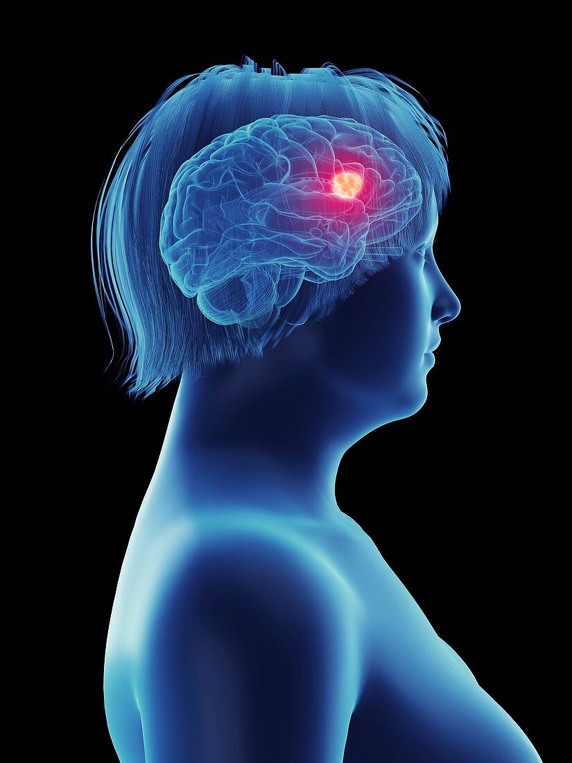 Illustration of a tumour in a woman's brain